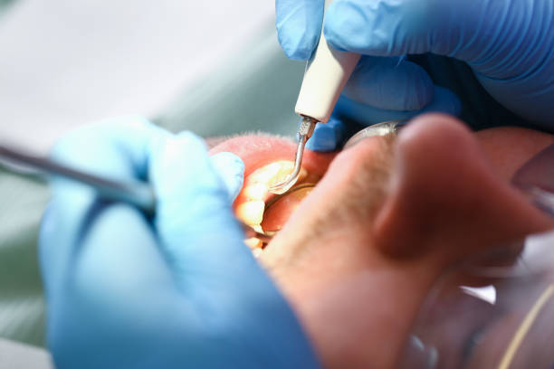 Best Emergency Tooth Extraction in Long Beach, WA