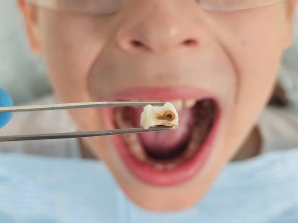Best Emergency Treatment for Dental Infections or Abscesses in Long Beach, WA